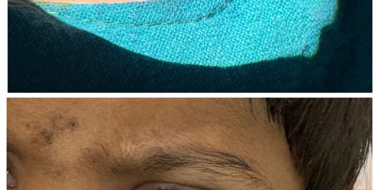 Ophthalmology team performs complex eyelid surgery, timely treatment saves eyesight