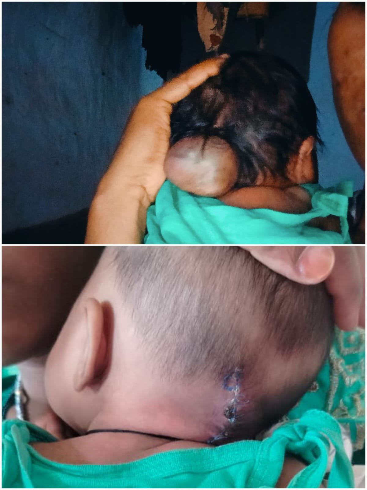 An innocent child's life saved through timely diagnosis, successful surgery in Raipur, and expert treatment.